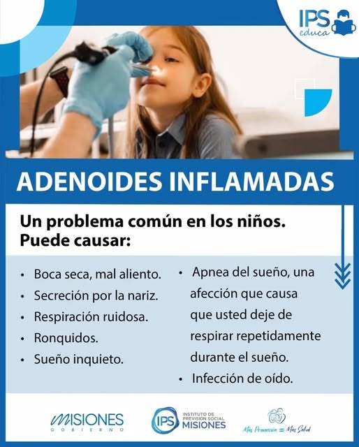 👃 ¿Adenoides inflamadas? Prestá atención a estos síntomas 7 👃 ¿Adenoides inflamadas? Prestá atención a estos síntomas imagen-6
