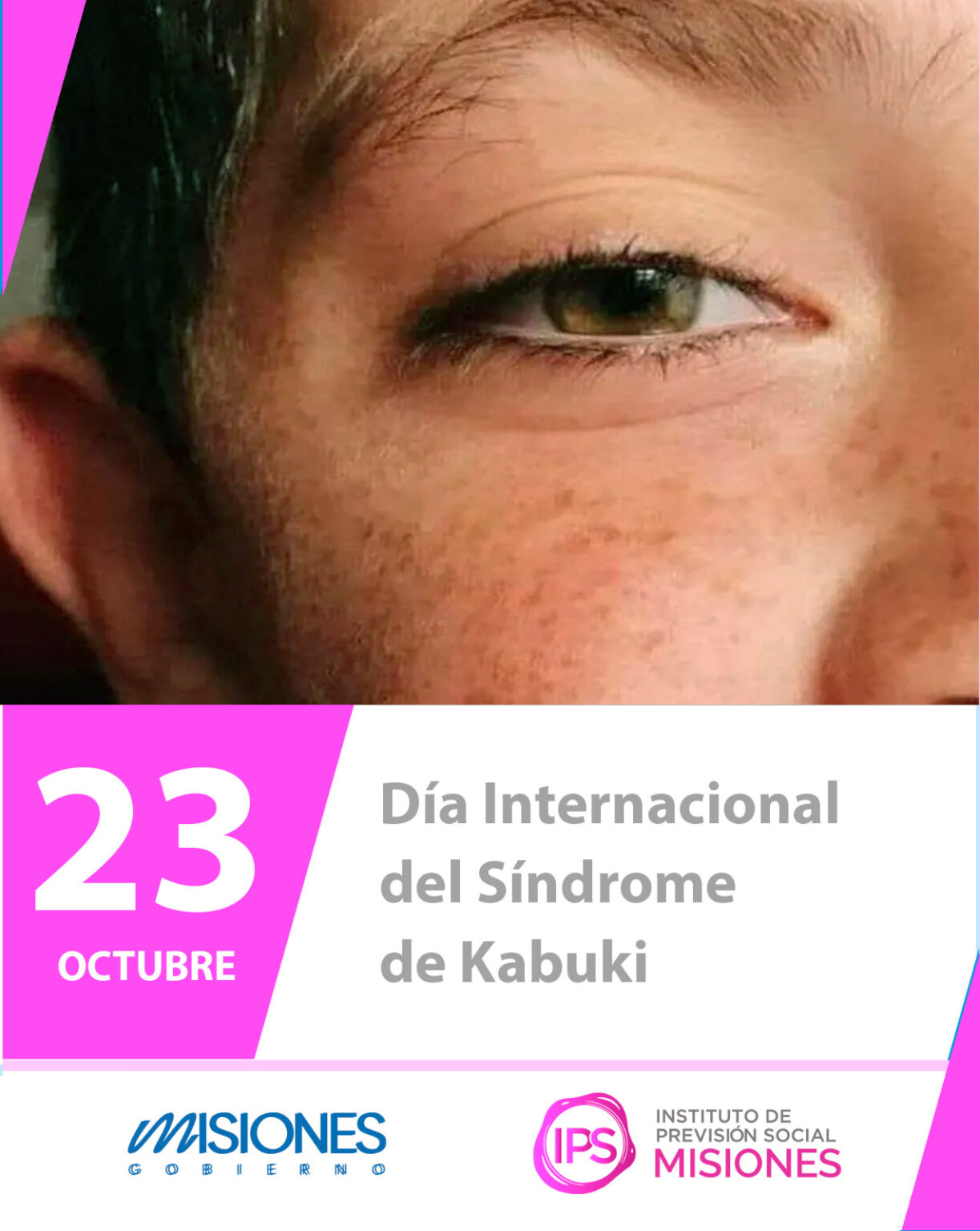🧬 23 de octubre | Día Internacional del Síndrome de Kabuki 9 🧬 23 de octubre | Día Internacional del Síndrome de Kabuki imagen-8